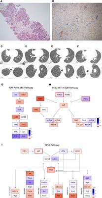 A Case Series of Metastatic Metaplastic Breast Carcinoma Treated With Anti-PD-1 Therapy